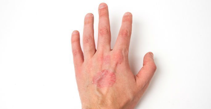 Psoriatic arthritis symptoms include inflammation in the hands, as shown here.