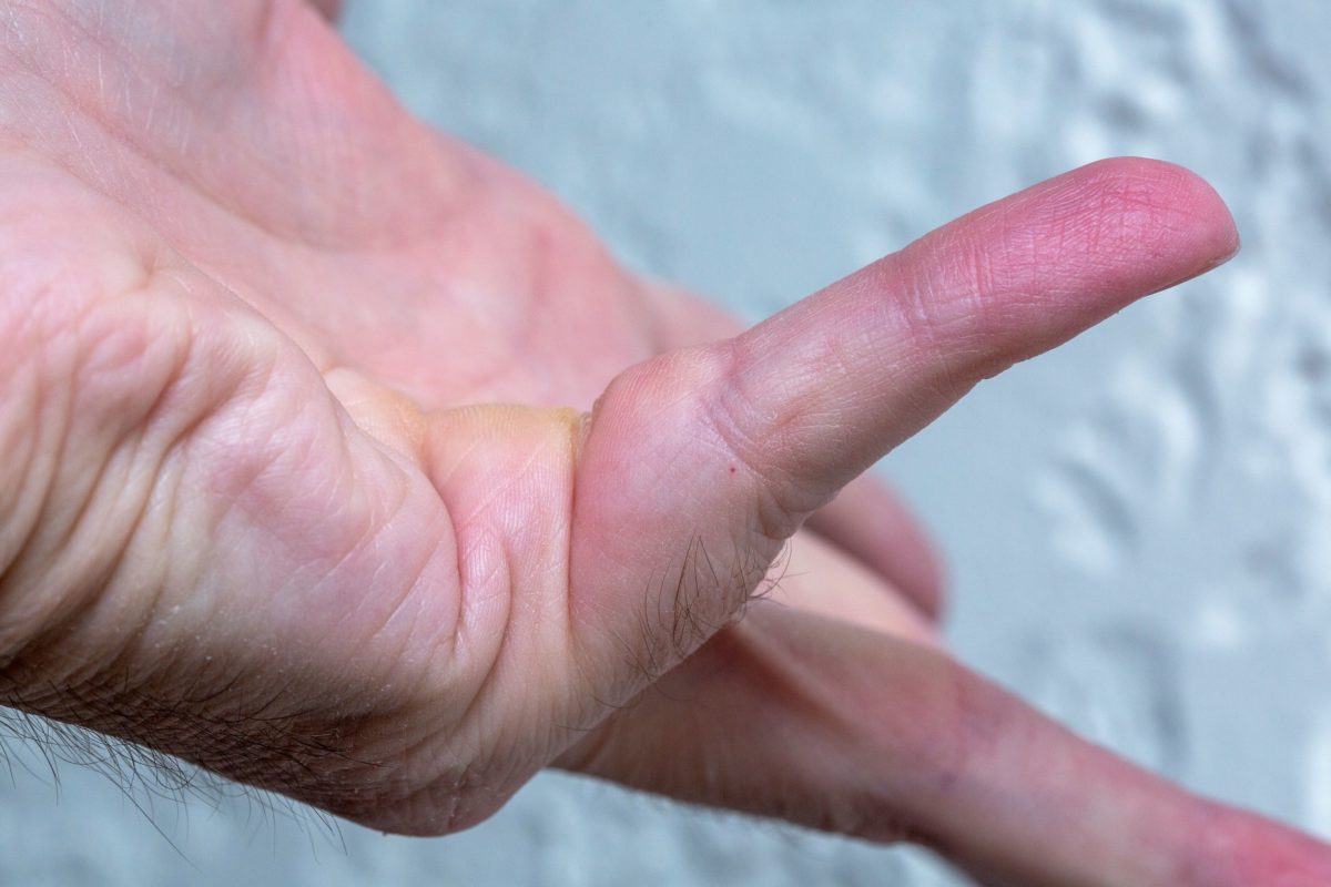 What is Dupuytren's contracture and what causes it? How is Dupuytren's contracture treated? These are some of the questions our hand doctor can answer. This is a closeup image of hand affected by the disease.