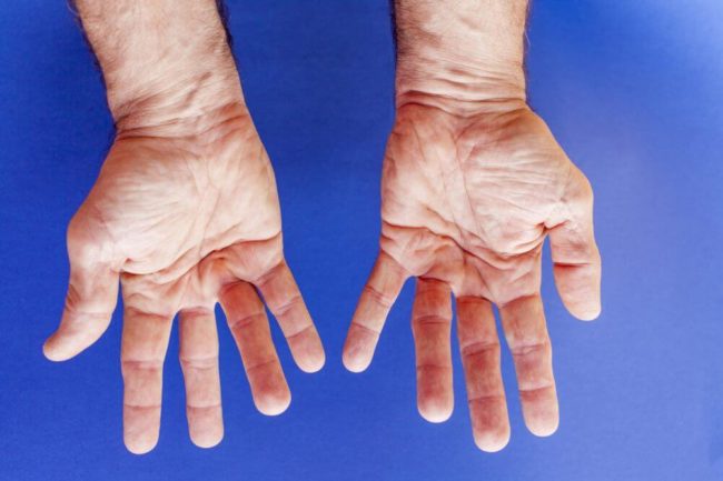 Can Dupuytren's contracure be cured? We treat this hand condition in our southeast Michigan hand doctor's offices. This image shows the palm side of the hands of a Dupuytren's contracture patient.
