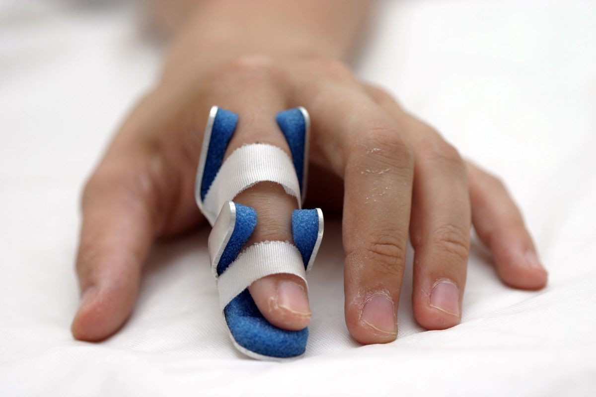 As shown here, a splint can be used to correct mallet finger if a hand doctor is seen soon after the finger injury.