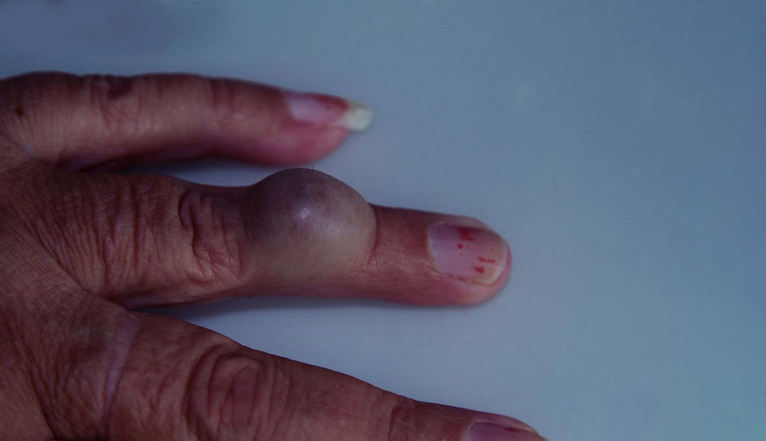 Treat Mucous Cysts On Fingers Top Hand Doctor Southeast Michigan