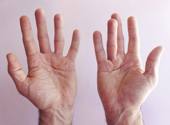 Is Dupuytren Contracture The Same As Trigger Finger