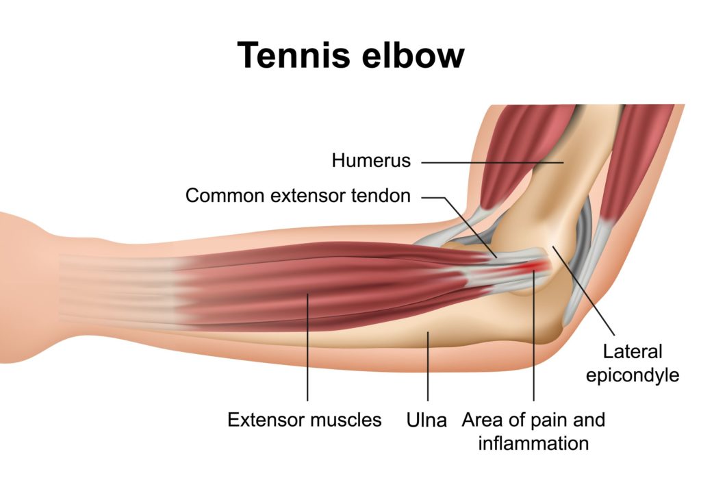 Tennis elbow occurs due to overuse of the elbow’s outer tendons. This diagram shows the anatomy of the elbow in relation to tennis elbow.