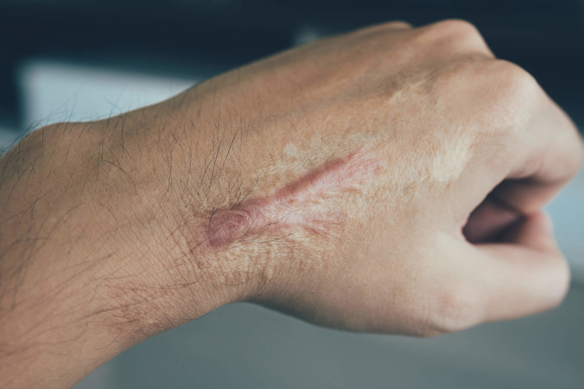 The type and extent of a scar will determine the best hand scar removal and treatment options, as represented by this image of a scar on a man's hand.