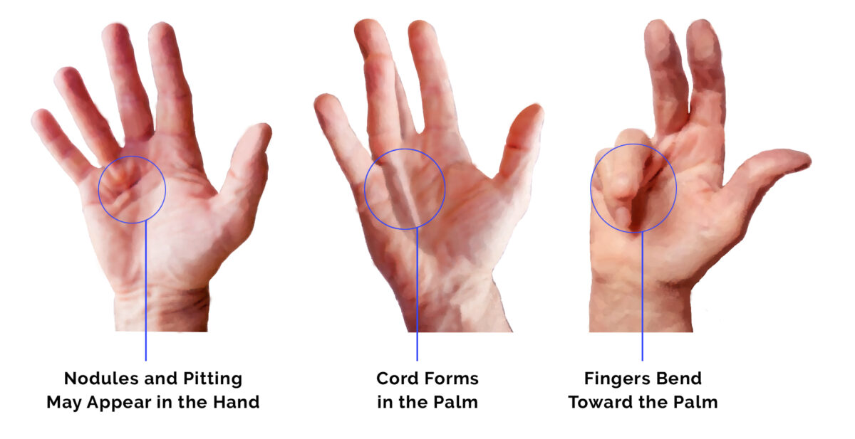 Dupuytren’s Contracture or “Viking finger”