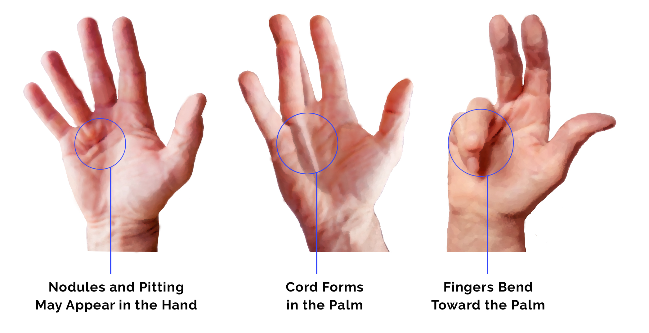 Symptoms and Treatment for a Bent Finger