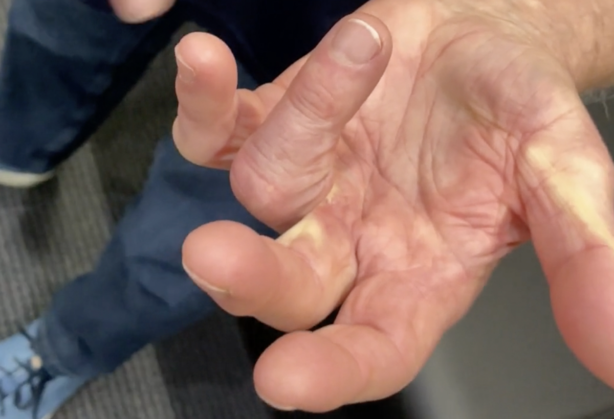 Identify Symptoms of Trigger Finger and Understand Your Medical Treatment Options